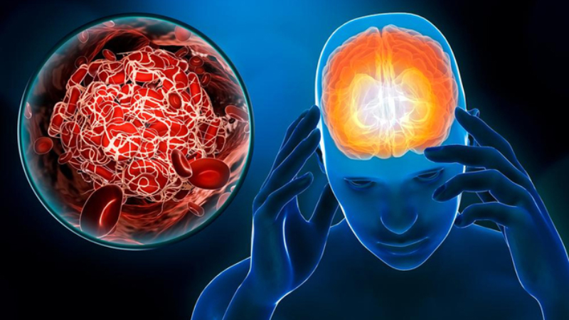 Phân hủy mảng bám Amyloid: Bảo vệ não, tăng trí nhớ